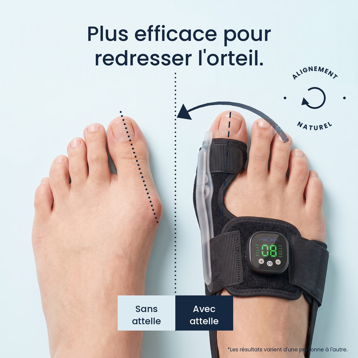 Attelle EMS Orveline : l'orteil se redresse, sans attelle vs avec attelle